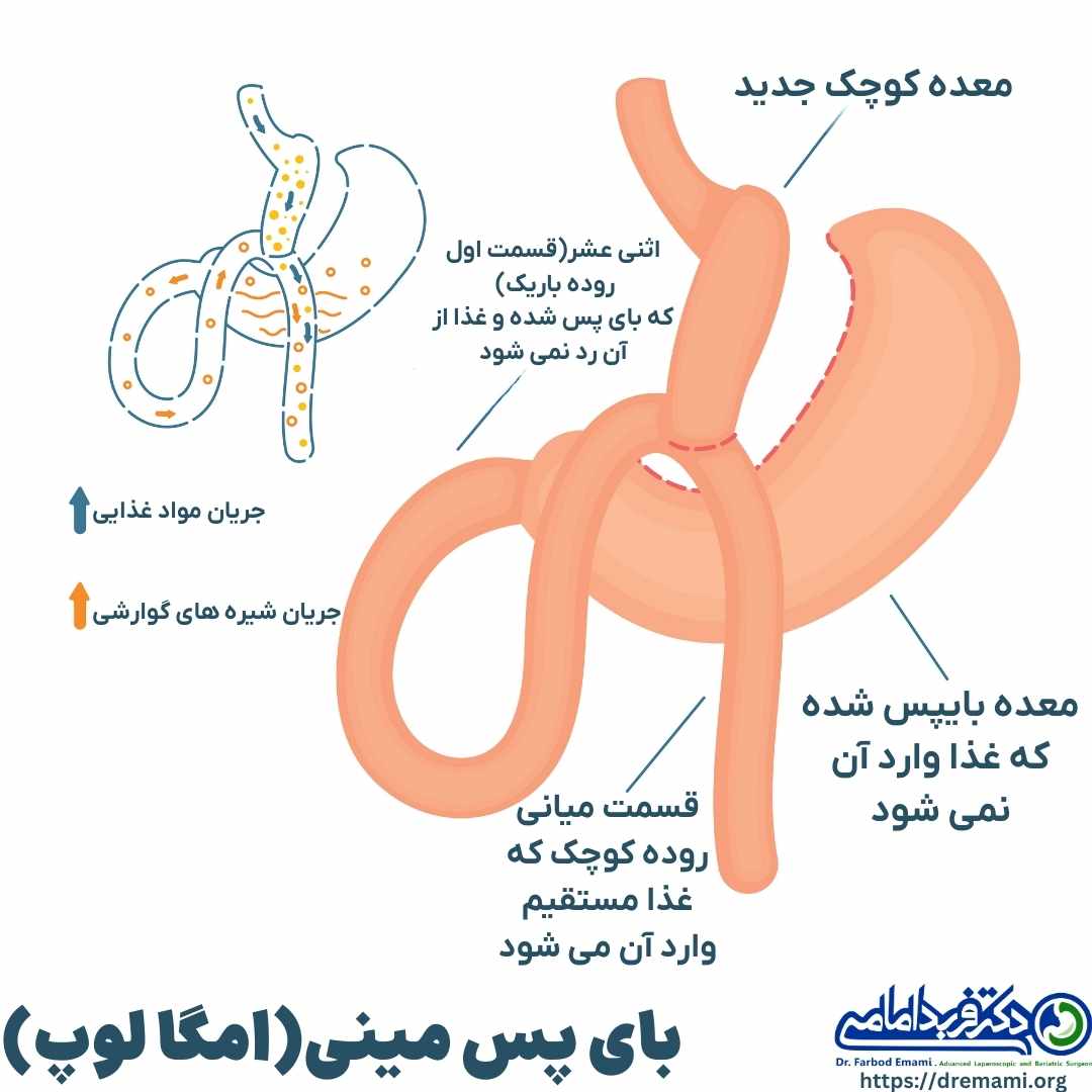 مکانیزم عمل مینی بای پس معده