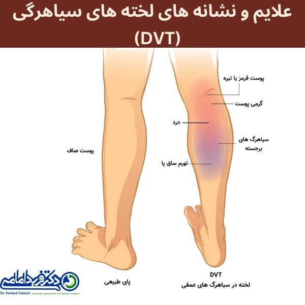 علایم و نشانه های لخته های داخل عروقی پا