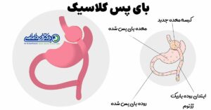 نحوه انجام عمل بای پس کلاسیک