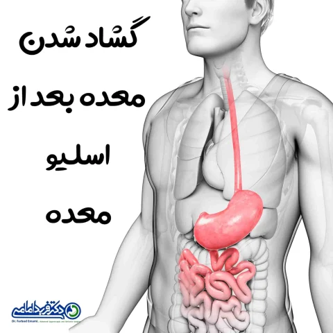 گشاد شدن معده بعد از اسلیو