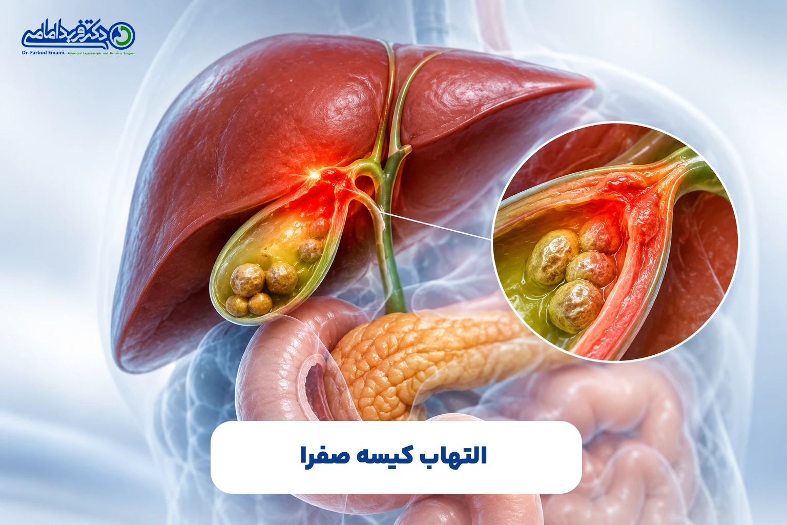 التهاب کیسه صفرا