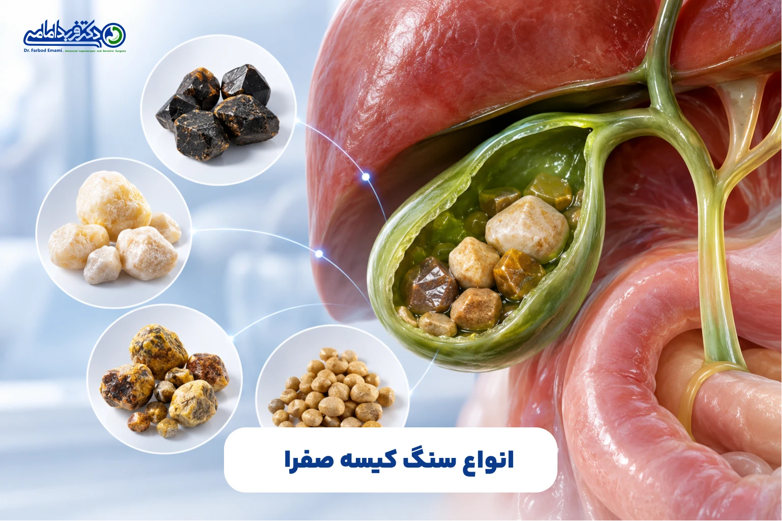 انواع سنگ کیسه صفرا