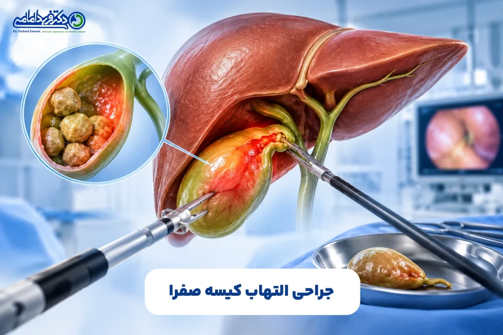 جراحی التهاب کیسه صفرا
