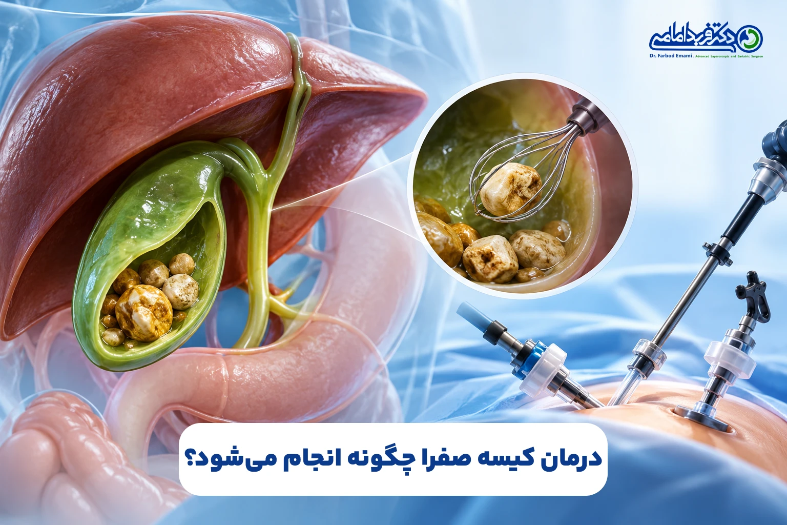 درمان کیسه صفرا چگونه انجام میشود؟