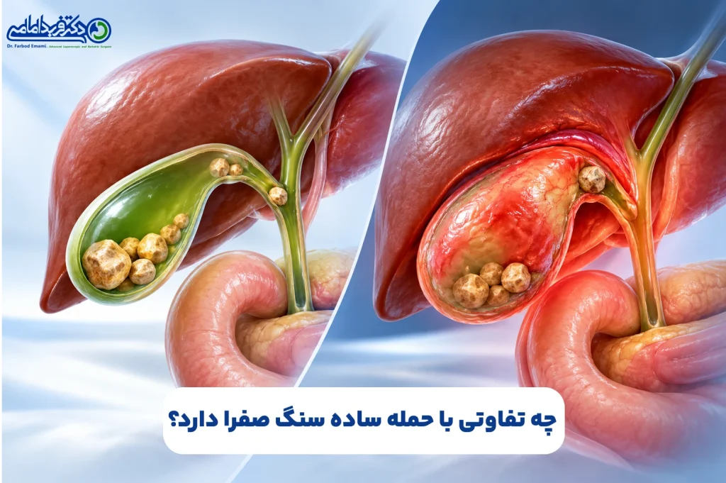 چه تفاوتی با حمله ساده سنگ صفرا دارد؟