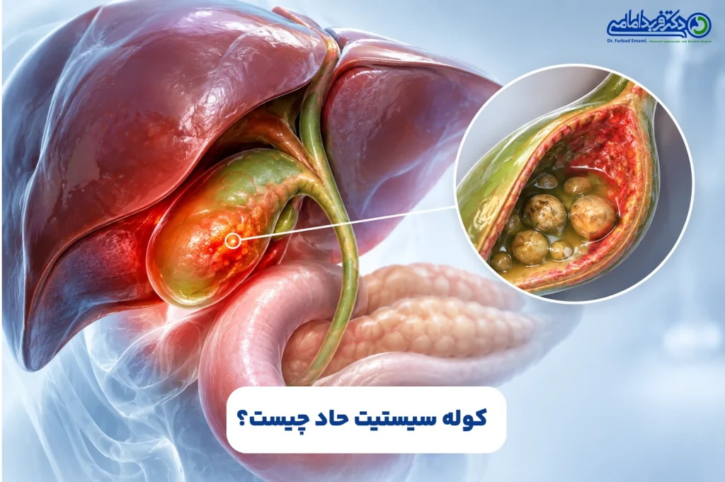 کوله‌سیستیت چیست